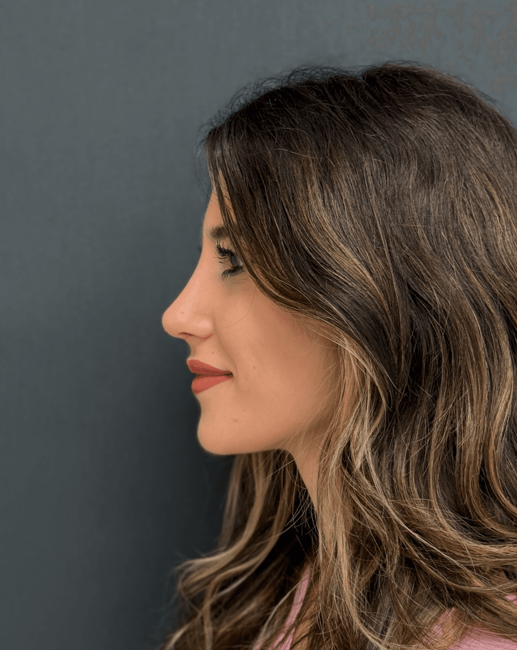 Rhinoplasty Case 1 - After