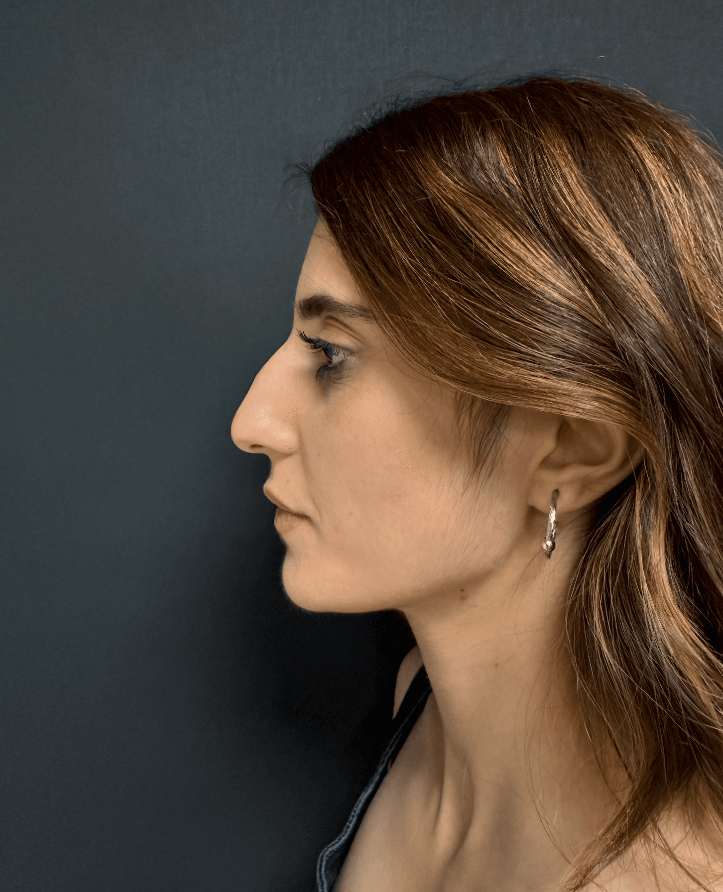 Rhinoplasty Case 1 - Before